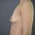 Mastopexia con Implantes 300cc