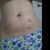 La carboxiterapia y la hidrolipoclasia las recomiendo 100%