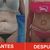 Lipoabdominoplastia. Dr José Miguel Sandoval Rodríguez. Clínica El Pinar