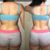 Lipolisis laser con lipotransferencia