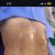 Mi lipotransferencia  con el Dr. Felipe Galiano