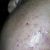 ☹ tengo miedo que el acné me deje secuelas ☹