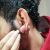 Cicatriz queloide en la oreja 