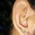 Cicatriz queloide en la oreja 
