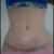 Recuperándome de una abdominoplastia