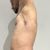 Lipoescultura con transferencias y abdominoplastia