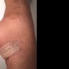 Gluteoplastia, muy profesional, excelente doctor