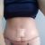 Un deseo aplazado, abdominoplastia llegó la hora