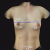 Porqué existen diferentes perfiles o proyecciones en implantes mamarios? 