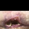 Decepcionada de mi lipectomia (tummy tuck)