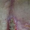 Decepcionada de mi lipectomia (tummy tuck)