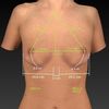 Implantes de seno!. Como elegir el tamaño correcto? 
