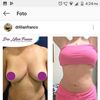 J.plasma para no hacer abdominoplastia