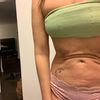 Reparación de abdomen 