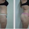 Precio de lipoescultura y lipotransferencia de gluteos
