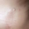 Pues no sé quiero borrarme.esta sicatris de mi cuello