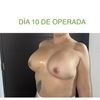 Aumento mamario con prótesis Motiva 2, 350cc