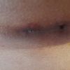 Cicatrización post mamoplastia de aumento
