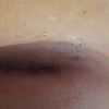Cicatrización post mamoplastia de aumento