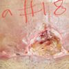 necrosis despues de una lipo-abdominoplastia