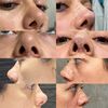 Alas nasales asimétricas