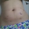 carboxiterapia e hidrolipoclasia 