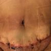 Mi costura de abdominoplastia quedó con pliegues fea .