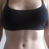 Las mejores abdominoplastias ♥
