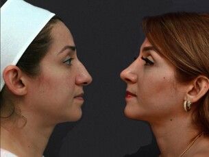 Rinoplastia 10% de Descuento