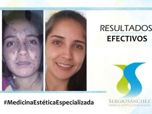 20% de descuento en Tratamiento de acné y cicatrices