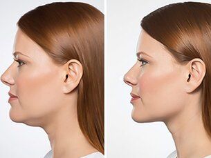 Perfilación mandibular (Lipopapada Láser) -10%