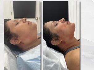 Reducción de papada (hidrolipodilución)