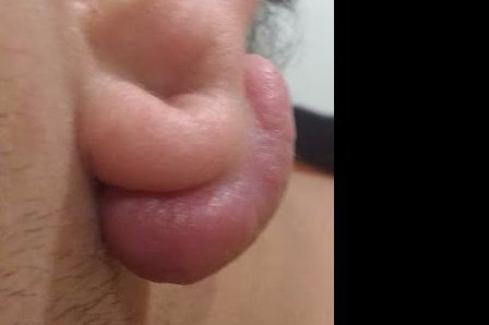Queloide en el lóbulo de la oreja
