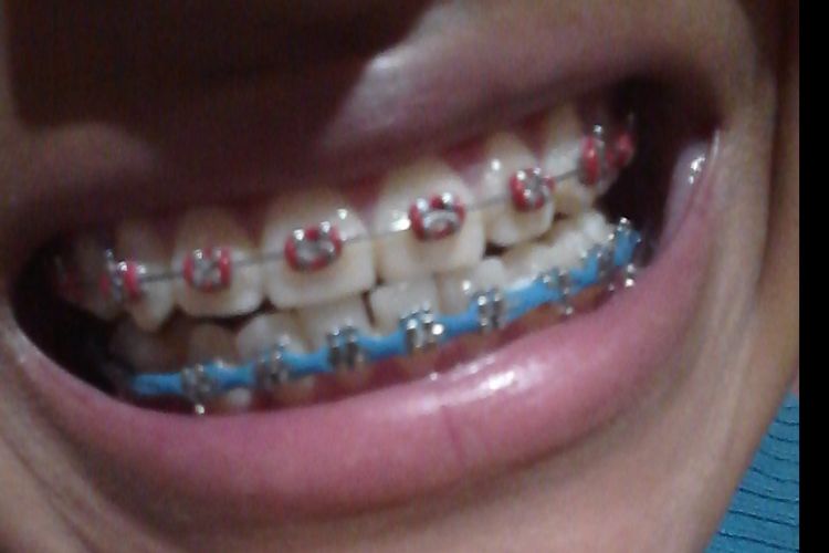 ¿Que valor tiene un diseño de sonrisa y blanqueamiento?