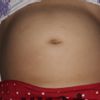 ¿Cuál es el precio de una abdominoplastia?