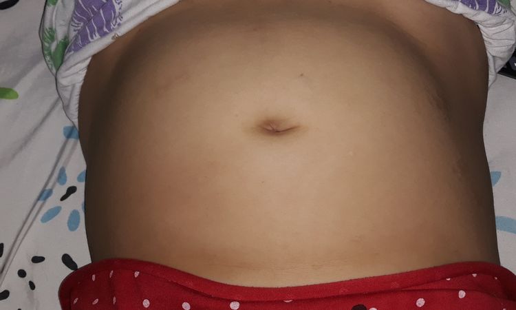 ¿Cuál es el precio de una abdominoplastia? - 4479