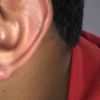 queloide en lobulo de la oreja en medellin, mejor tratamiento - 5808