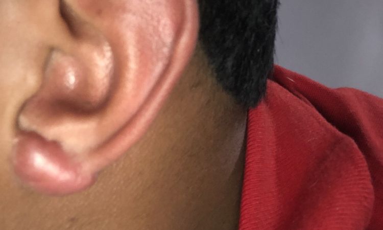 queloide en lobulo de la oreja en medellin, mejor tratamiento - 5808