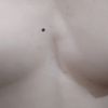 Precio cirugia ginecomastia?