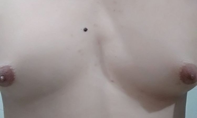 Precio cirugia ginecomastia? - 5881