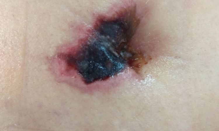 Estoy recibiendo tratamiento apropiado? Necrosis en el ombligo? - 7039