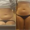 ¿Lipolisis, liposucción o lipectomía?