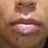 Como reducir el tamaño del labio por una cicatriz? - 7812
