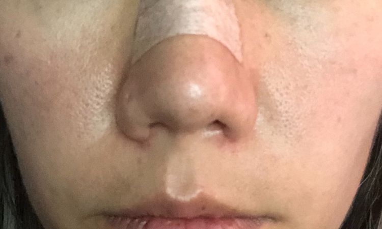 Columela retraída después de rinoplastia - 8233