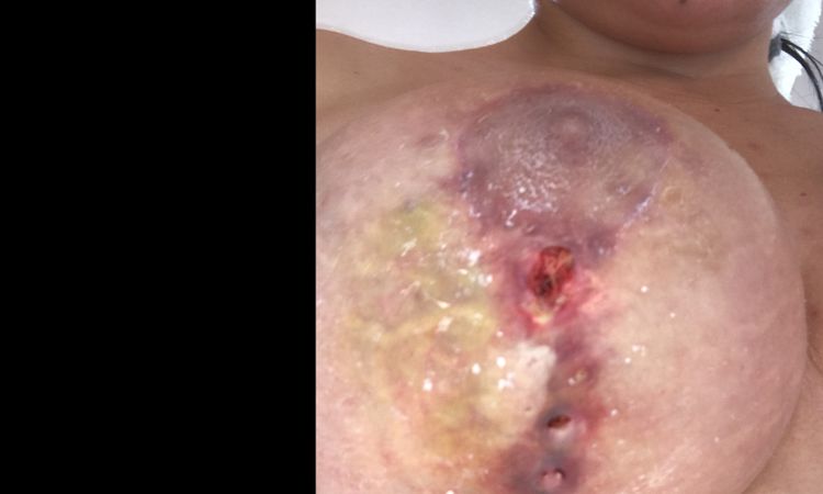 Proceso de mastopexia - 8414