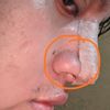 Colapso Válvula nasal - 12217
