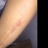 ¿puede desaparecer una cicatriz de un brazo, causa de una cirugía?