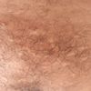 Cicatrices en el pubis por depilacion láser - 12397