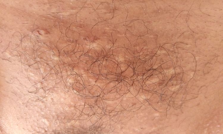 Cicatrices en el pubis por depilacion láser - 12397