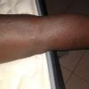 Lesiones en la piel de mi hijo - 12446
